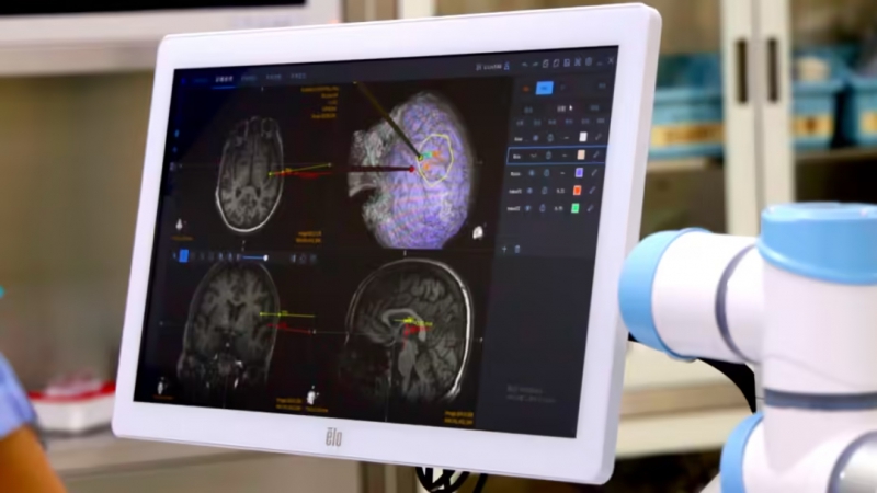 全球首例!我国无线植入式脑机接口让渐冻症患者重获“语言新生”(图1) 全球首例!我国无线植入式脑机接口让渐冻症患者重获“语言新生”(图1)